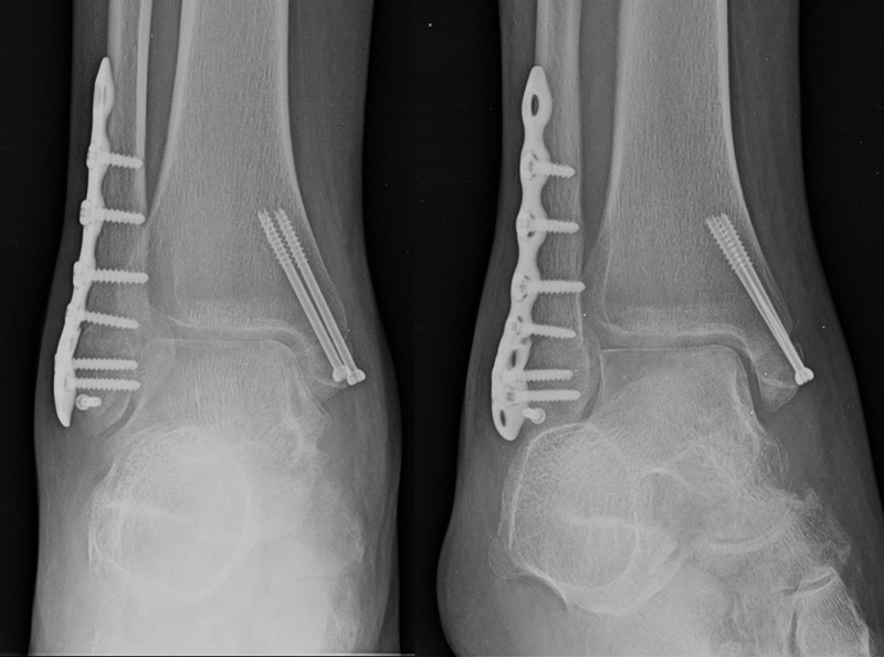 Case 1 AP and Oblique XRays
